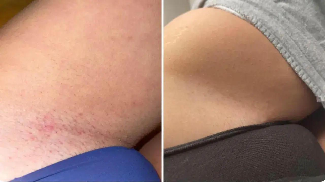 Vorher-Nachher-Vergleich einer Intimrasur bei Frauen. Links Rötungen und Härchen, rechts glatte Haut.