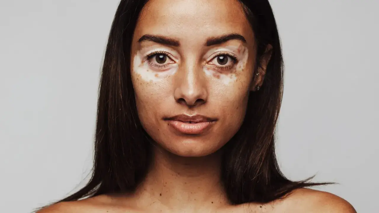 Porträt einer Frau mit Vitiligo. Sie fragt sich, wie werde ich braun mit heller haut, um ihre Haut gleichmäßiger zu bekommen.
