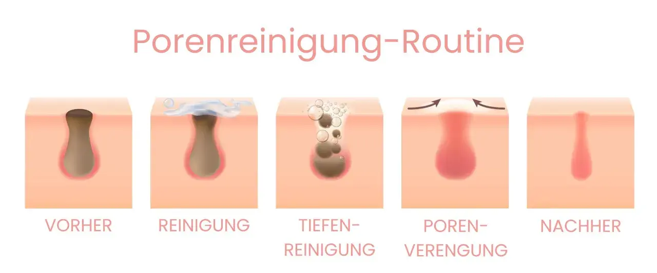 Illustration zeigt die Schritte einer Porenreinigung, wie Mitesser entfernen Hausmittel helfen können, die Poren zu verengen und zu reinigen.