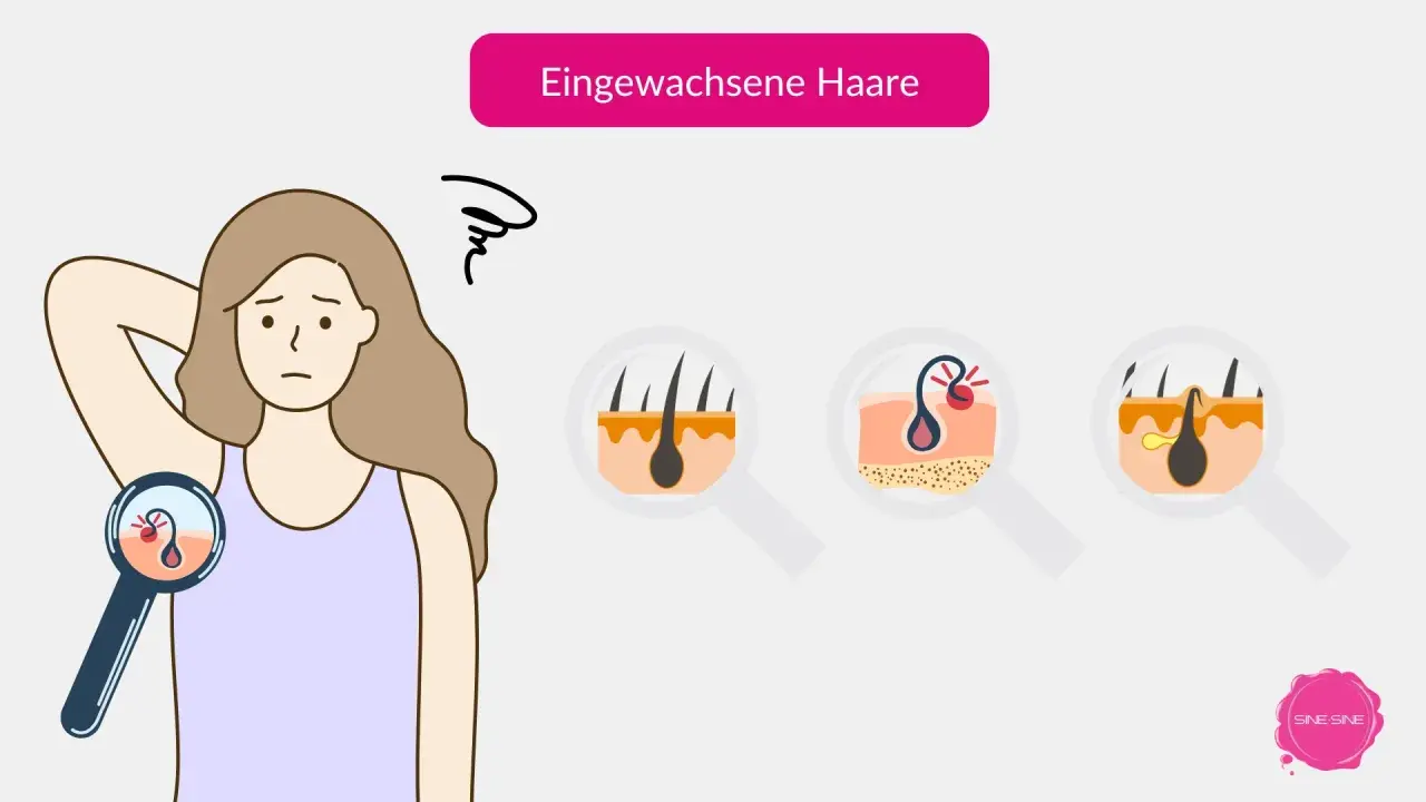 Eine Frau mit besorgtem Gesichtsausdruck betrachtet ihre Haut unter einer Lupe. Nahaufnahmen zeigen, wie Haare nach dem Epilieren unter der Haut wachsen und Entzündungen verursachen.