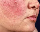 Haut mit roten Flecken und Pusteln, möglicherweise Rosazea, die in den Wechseljahren auftreten kann.