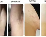 Vorher/Nachher-Bilder zeigen Achseln mit roten Pickeln, die nach der Anwendung glatter und reizfreier sind. Rasierpickel gehen nicht weg? Hier die Lösung.