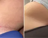 Vorher-Nachher-Vergleich einer Intimrasur bei Frauen. Links Rötungen und Härchen, rechts glatte Haut.
