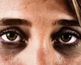 Nahaufnahme eines Gesichts mit deutlichen Augenringen, die trotz ausreichend Schlaf vorhanden sind. Die Haut wirkt müde und leicht gerötet.