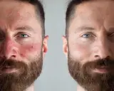Vorher-Nachher-Vergleich: Ein Gesicht mit Couperose und Rötungen wird mit einem klaren, ebenmäßigen Hautbild gezeigt.