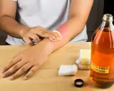 Person tupft gerötete Haut mit Wattepad ein, daneben Flasche Apfelessig.