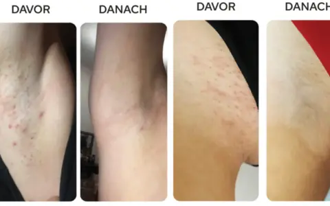Vorher/Nachher-Bilder zeigen Achseln mit roten Pickeln, die nach der Anwendung glatter und reizfreier sind. Rasierpickel gehen nicht weg? Hier die Lösung.