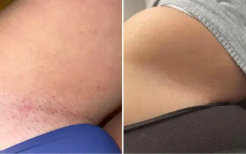 Vorher-Nachher-Vergleich einer Intimrasur bei Frauen. Links Rötungen und Härchen, rechts glatte Haut.