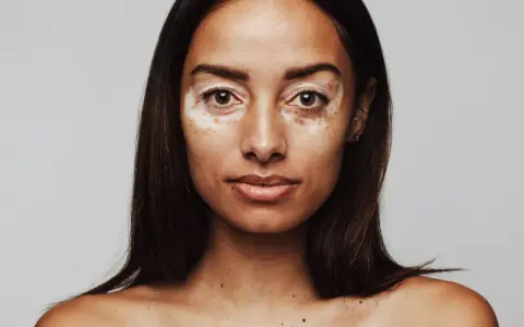 Porträt einer Frau mit Vitiligo. Sie fragt sich, wie werde ich braun mit heller haut, um ihre Haut gleichmäßiger zu bekommen.