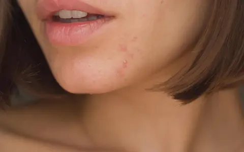 Nahaufnahme von Lippen und Kinn mit einigen Pickeln. Die Bedeutung von Pickeln am Kinn kann vielfältig sein, oft hormonell bedingt.
