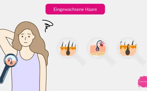 Eine Frau mit besorgtem Gesichtsausdruck betrachtet ihre Haut unter einer Lupe. Nahaufnahmen zeigen, wie Haare nach dem Epilieren unter der Haut wachsen und Entzündungen verursachen.