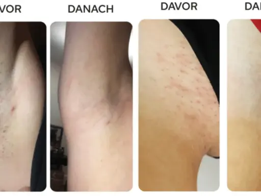 Vorher/Nachher-Bilder zeigen Achseln mit roten Pickeln, die nach der Anwendung glatter und reizfreier sind. Rasierpickel gehen nicht weg? Hier die Lösung.