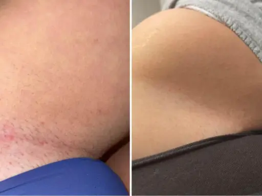 Vorher-Nachher-Vergleich einer Intimrasur bei Frauen. Links Rötungen und Härchen, rechts glatte Haut.
