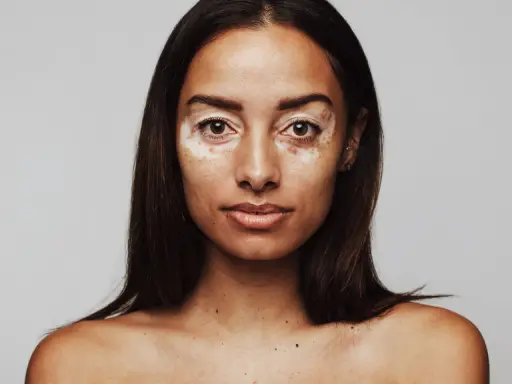 Porträt einer Frau mit Vitiligo. Sie fragt sich, wie werde ich braun mit heller haut, um ihre Haut gleichmäßiger zu bekommen.
