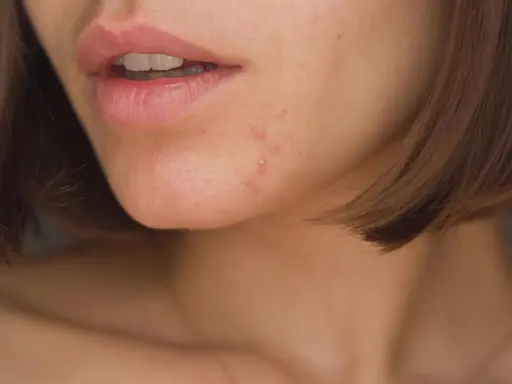 Nahaufnahme von Lippen und Kinn mit einigen Pickeln. Die Bedeutung von Pickeln am Kinn kann vielfältig sein, oft hormonell bedingt.