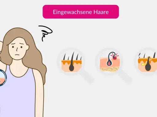 Eine Frau mit besorgtem Gesichtsausdruck betrachtet ihre Haut unter einer Lupe. Nahaufnahmen zeigen, wie Haare nach dem Epilieren unter der Haut wachsen und Entzündungen verursachen.