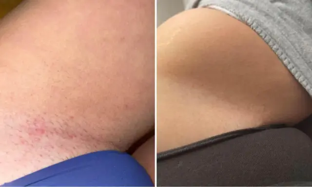 Vorher-Nachher-Vergleich einer Intimrasur bei Frauen. Links Rötungen und Härchen, rechts glatte Haut.
