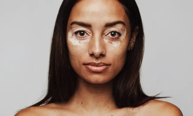 Porträt einer Frau mit Vitiligo. Sie fragt sich, wie werde ich braun mit heller haut, um ihre Haut gleichmäßiger zu bekommen.