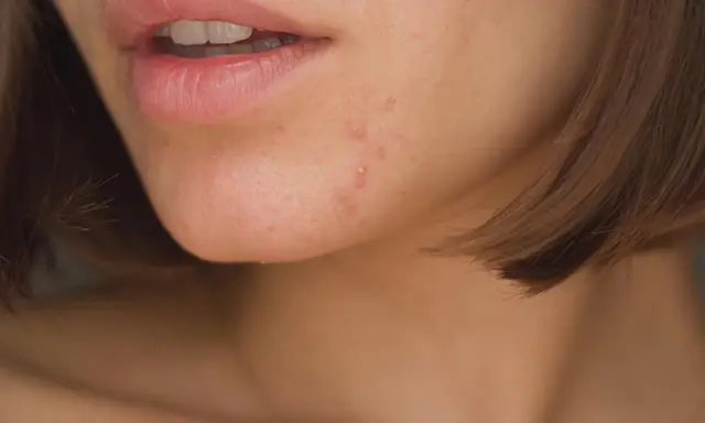 Nahaufnahme von Lippen und Kinn mit einigen Pickeln. Die Bedeutung von Pickeln am Kinn kann vielfältig sein, oft hormonell bedingt.