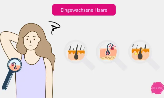 Eine Frau mit besorgtem Gesichtsausdruck betrachtet ihre Haut unter einer Lupe. Nahaufnahmen zeigen, wie Haare nach dem Epilieren unter der Haut wachsen und Entzündungen verursachen.
