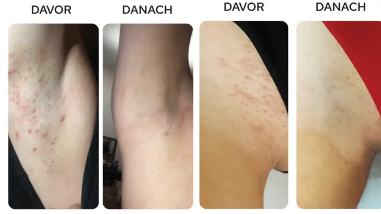 Vorher/Nachher-Vergleich von Achselhaaren bei Frauen. Die Bilder zeigen Rötungen und Pickelchen nach der Rasur, die sich nach der Anwendung verbessern.