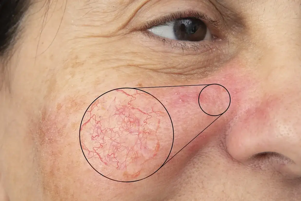 Nahaufnahme eines couperose gesichts mit sichtbaren &Auml;derchen, die durch eine Lupe vergr&ouml;&szlig;ert werden.