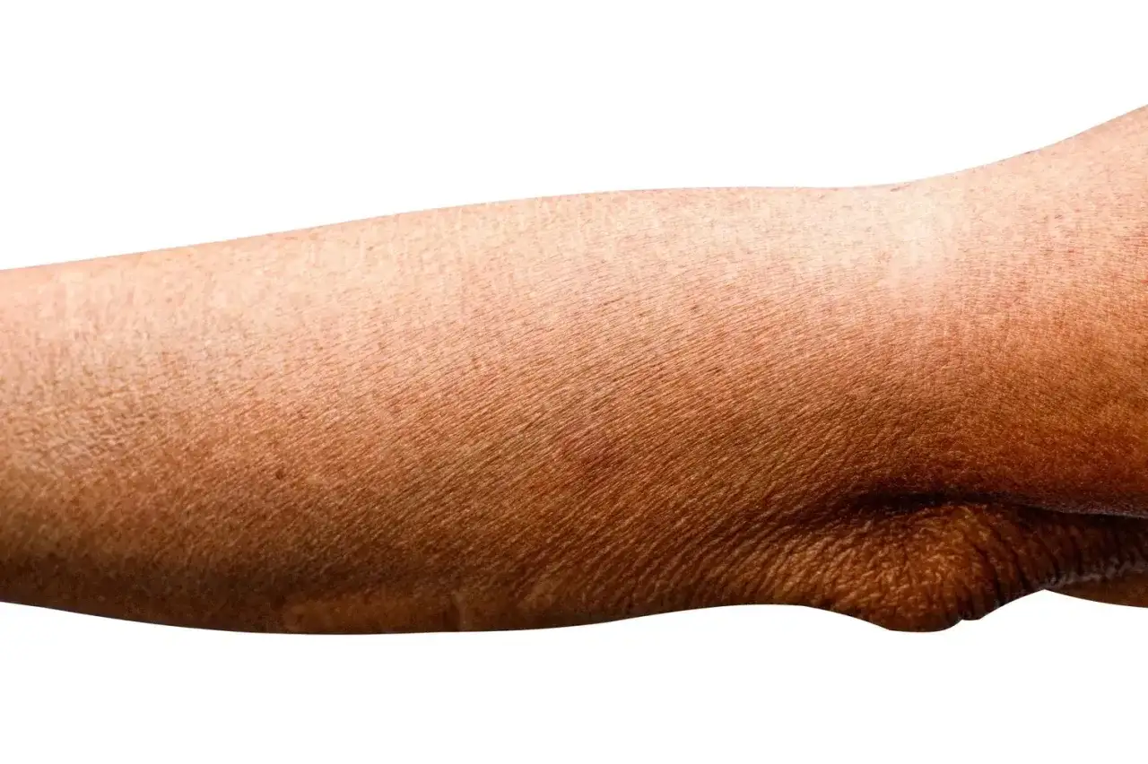 Nahaufnahme eines Arms mit trockener, faltiger Haut, die die Spuren der Zeit und des Lebens zeigt.