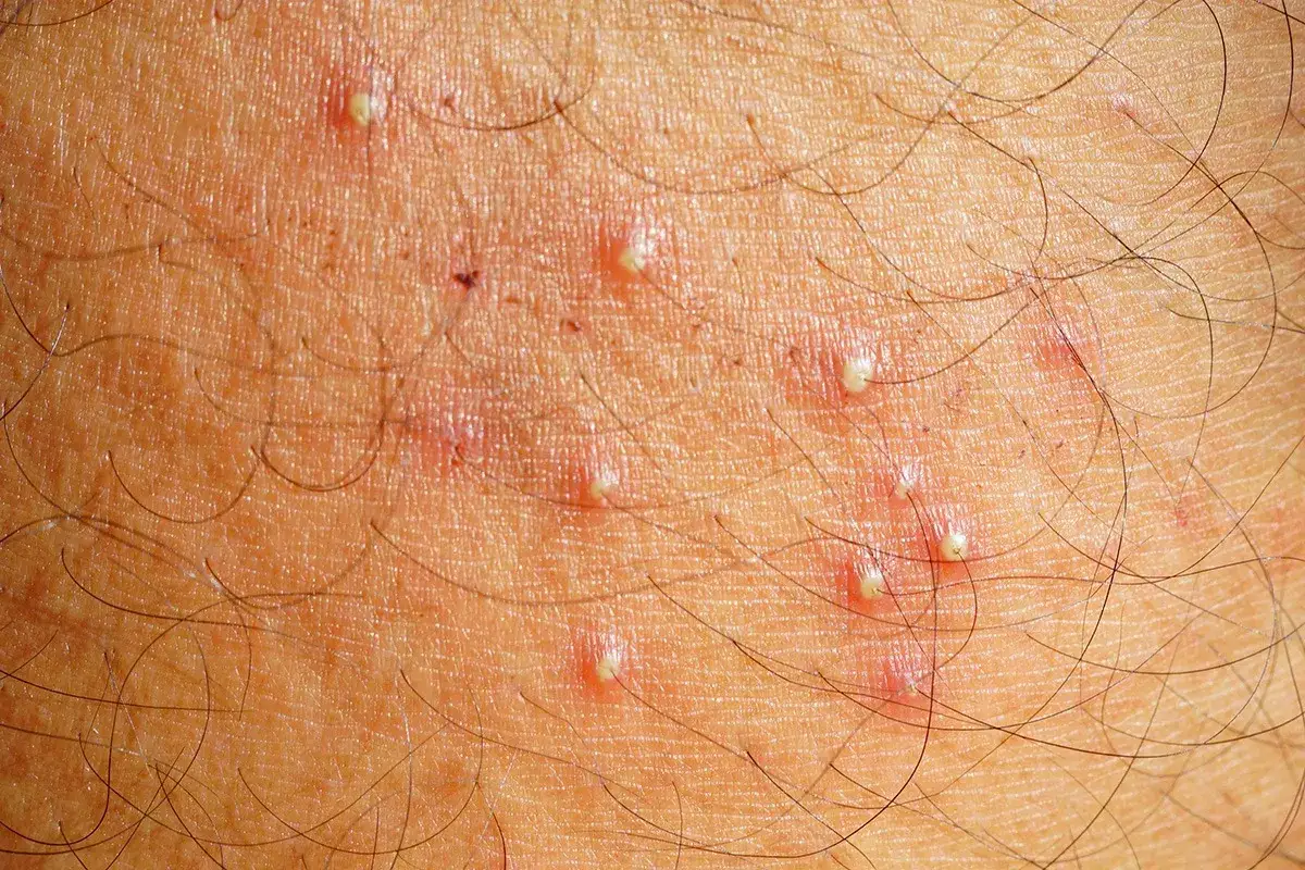 Hautirritationen mit kleinen Pusteln und roten Stellen, typisch für eingewachsene Haare nach dem Epilieren.